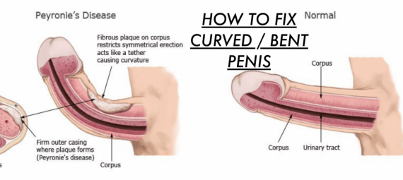 HOW-TO-STRAIGHTEN-A-CURVED-BENT-PENIS-AKA-PEYRONIE-DISEASE-FIX-IT-HERE-CURVATURE-BEFORE-AFTER-RESULTS-PENIS-ERECT-ERECTION-BENDING-ALFA-STALLION