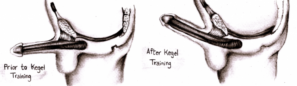 And after exercises before kegel Kegels Results