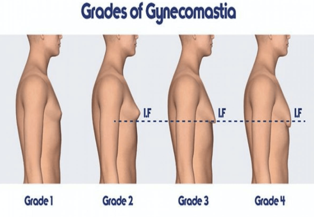 HOW-TO-GET-RID-OF-MANS-BOOBS-KNOWN-AS-GYNECOMASTIA-FLUFFY-NIPPLES-IN-MEN-GYNO-GRADES-MALE-BREAST-TITS-TITTIES-FATTY-TISSUES-BEFORE-AFTER-RESULTS-REVIEW-REVIEWS-GYNECTROL-ALFA-STALLION