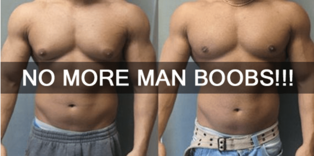 HOW-TO-GET-RID-OF-MANS-BOOBS-KNOWN-AS-GYNECOMASTIA-FLUFFY-NIPPLES-IN-MEN-GYNO-MALE-BREAST-TITS-NO-MORE-FATTY-TISSUES-BEFORE-AFTER-RESULTS-REVIEW-REVIEWS-GYNECTROL-RESULTS-LIPSUCTION-ALFA-STALLION