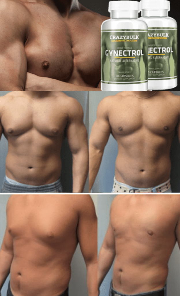 HOW-TO-GET-RID-OF-MANS-BOOBS-KNOWN-AS-GYNECOMASTIA-FLUFFY-NIPPLES-IN-MEN-GYNO-MALE-BREAST-TITS-TITTIES-FATTY-TISSUES-BEFORE-AFTER-RESULTS-REVIEW-REVIEW-GYNECTROL-RESULTS-LIPSUCTION-ALFA-STALLION