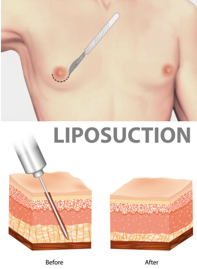 HOW-TO-GET-RID-OF-MANS-BOOBS-KNOWN-AS-GYNECOMASTIA-FLUFFY-NIPPLES-IN-MEN-GYNO-MALE-BREAST-TITS-TITTIES-FATTY-TISSUES-BEFORE-AFTER-RESULTS-REVIEW-REVIEWS-GYNECTROL-LIPSUCTION-ALFA-STALLION