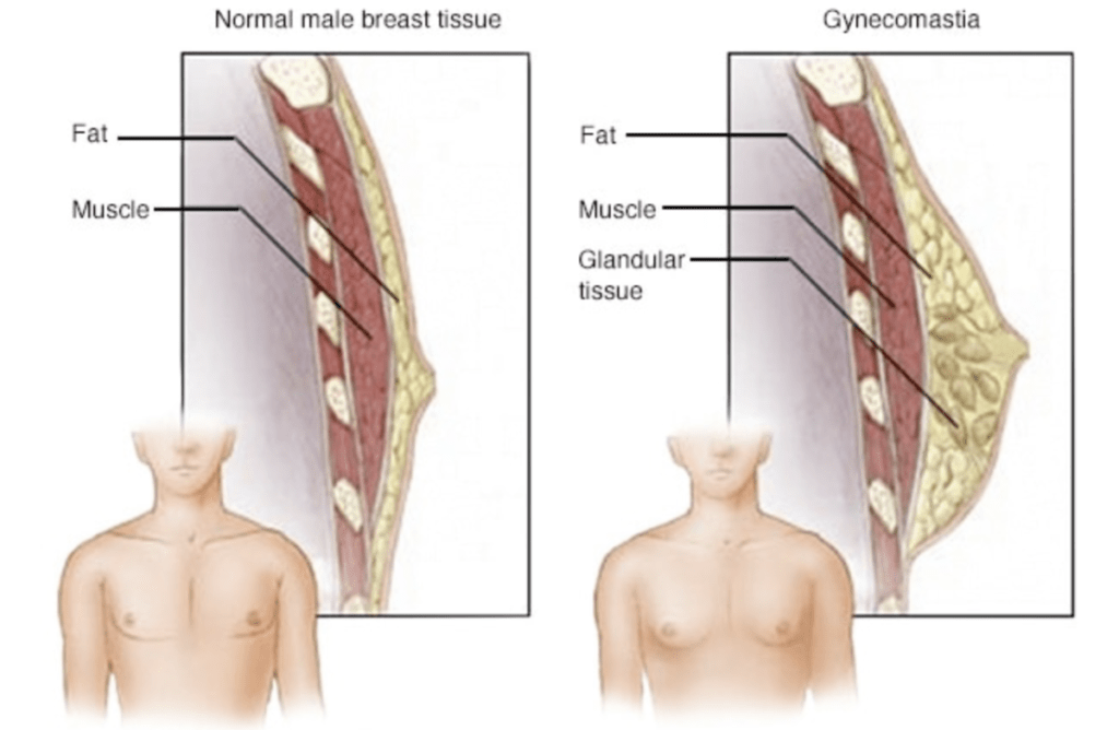 HOW-TO-GET-RID-OF-MANS-BOOBS-KNOWN-AS-GYNECOMASTIA-FLUFFY-NIPPLES-IN-MEN-GYNO-MALE-BREAST-TITS-TITTIES-FATTY-TISSUES-BEFORE-AFTER-RESULTS-REVIEW-REVIEWS-GYNECTROL-LIPSUCTION-PROCESS-ALFA-STALLION