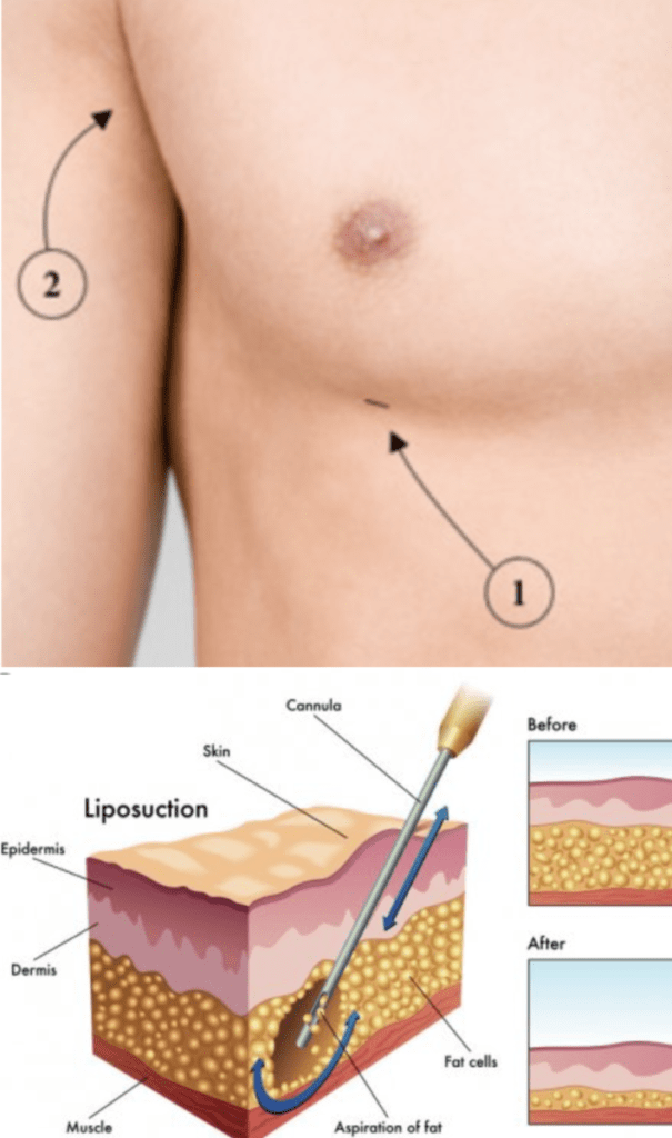 HOW-TO-GET-RID-OF-MANS-BOOBS-KNOWN-AS-GYNECOMASTIA-FLUFFY-NIPPLES-IN-MEN-GYNO-MALE-BREAST-TITS-TITTIES-FATTY-TISSUES-BEFORE-AFTER-RESULTS-REVIEW-REVIEWS-GYNECTROL-LIPSUCTION-SCARS-ALFA-STALLION