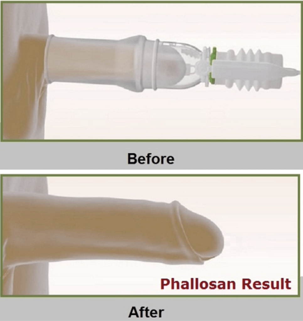 BEWARE-DONT-USE-PHALLOSAN-BEFORE-READING-THIS-PHALLOSAN-FORTE-REVIEW-BEFORE-AND-AFTER-RESULTS-ONLY-HERE-REVIEWS-HOW-TO-USE-IT-DOES-IT-REALLY-WORK-HOW-TO-WEAR-IT-PHALLOSAN-FORTE-GAINS-ALFA-STALLION